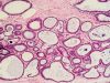 The biopsy debate