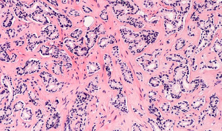 biopsy