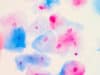 Jo’s Cervical Cancer Trust report Covid-19 screening challenges