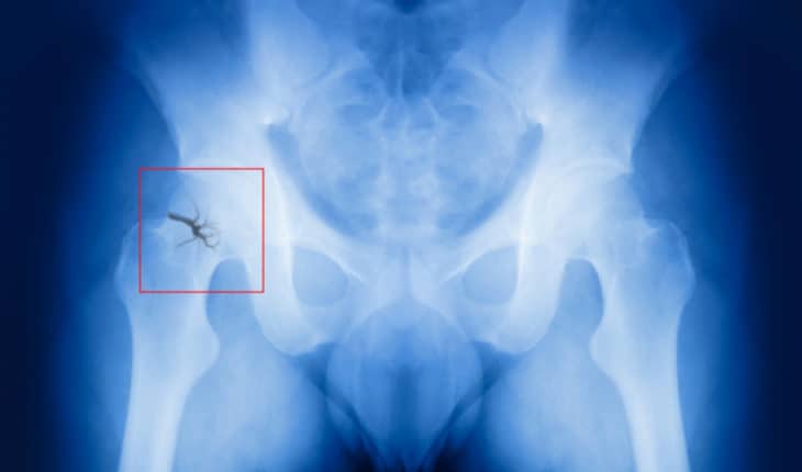 broken hip