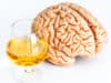 Alcohol related dementia: Vitamin B1 deficiency