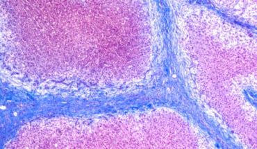 liver cirrhosis