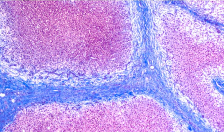 liver cirrhosis