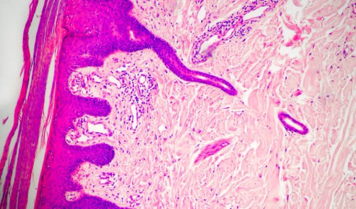development of psoriasis
