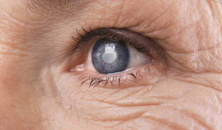 Alzheimer's and cataract surgery