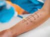 Whooping cough vaccine clinical trial to help prevent allergies