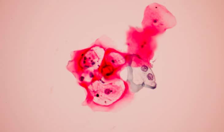 cervical cancer shame