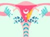 Support with weight after endometrial cancer