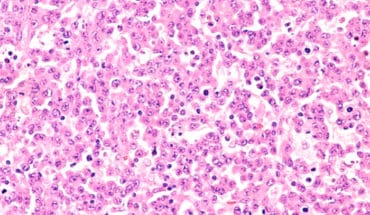 anaplastic large cell lymphoma