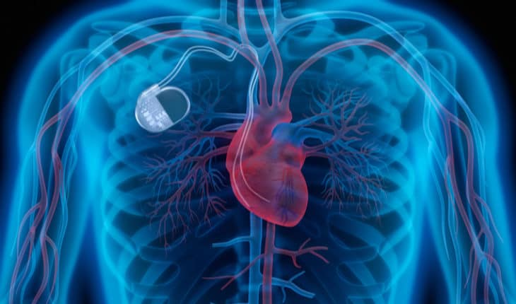pacemaker