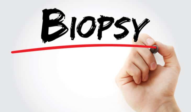 liquid biopsies