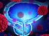 Cause of metastasis in prostate cancer discovered