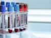 New blood biomarker: fatty liver disease
