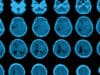 Understanding why deadly brain cancer comes back