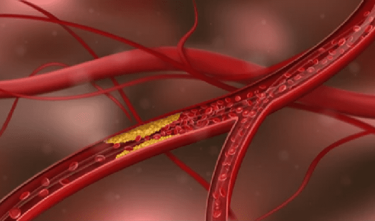 Atherosclerosis