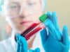 New treatment hope for chronic myeloid leukaemia