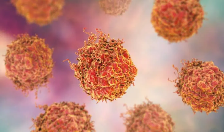 prostate cancer