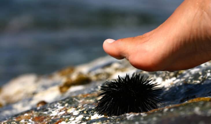 Embedded sea urchin spines and jelly fish stings