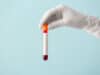 ‘Transformative’ blood test to identify molecular signatures