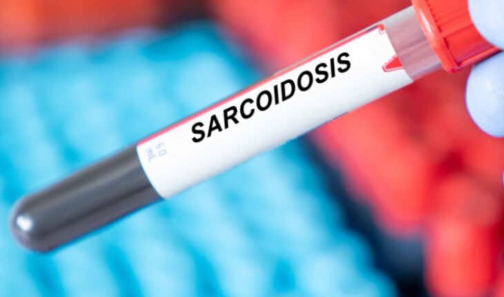 sarcoidosis