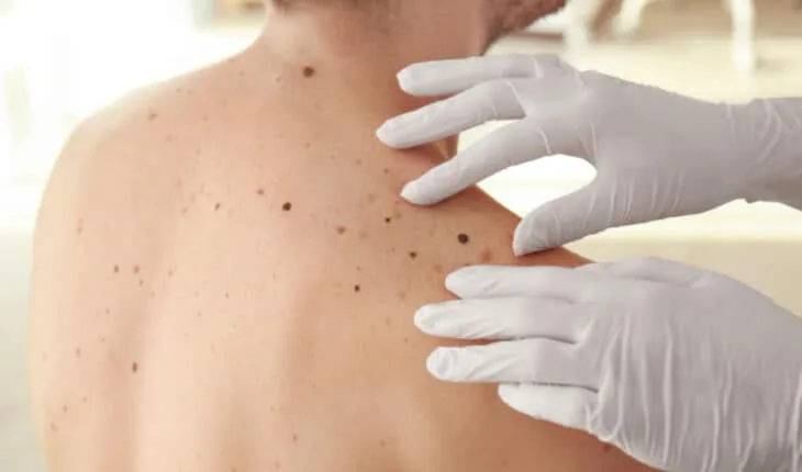 aggressive melanoma