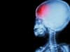 Advanced imaging predicts the recovery of children with brain injury