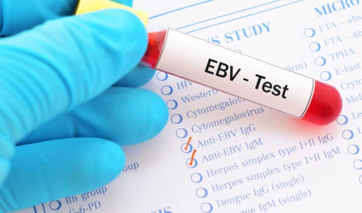 Epstein-Barr virus
