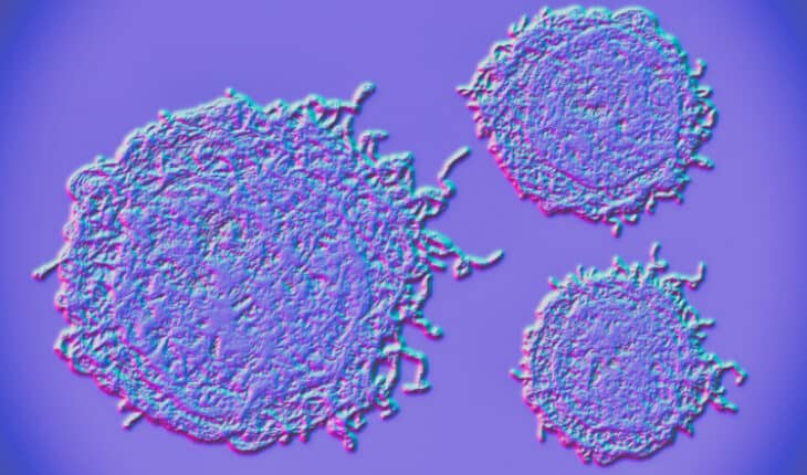 Neuroendocrine prostate cancer