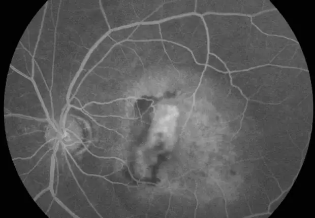 Close up of eyeball with blood vessels visible in white