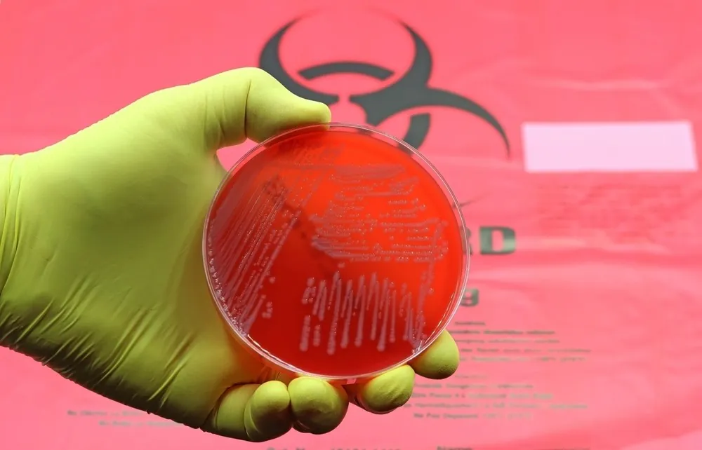 Superbug secrets revealed in new study A medium Agar-Blood Petri dish with a culture of the Superbug