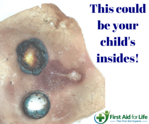 swallowed, button battery, first aid, help, child