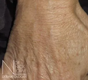 Before 1ML Polycaprolone Beads in Carbethoxycellulose Injections