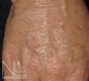 After 1ML Polycaprolone Beads in Carbethoxycellulose Injections