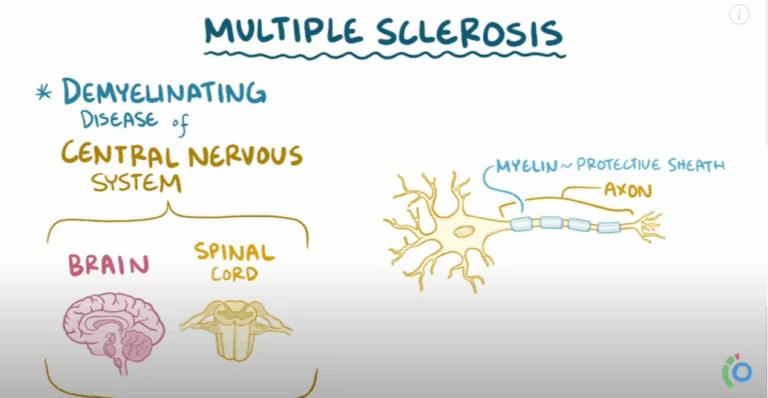 Multiple sclerosis – causes, symptoms, diagnosis, treatment, pathology