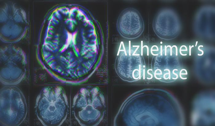 Single brain scan can diagnose Alzheimer’s disease