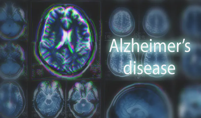 Single brain scan can diagnose Alzheimer’s disease