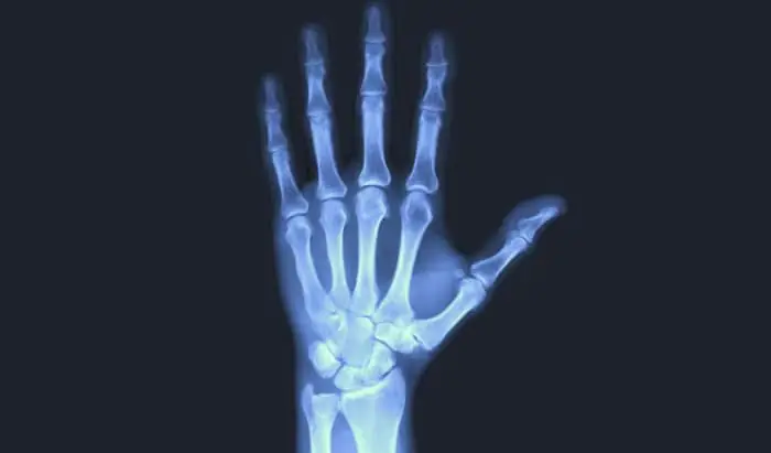 Bioengineering breakthrough could improve bone regeneration treatments