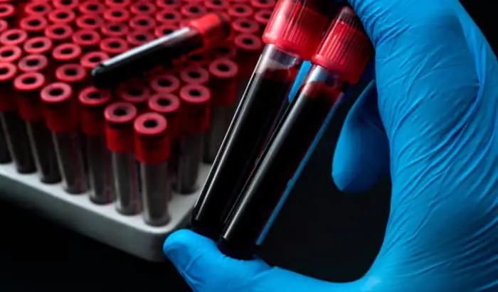 New HIV and Hepatitis cases identified HIV