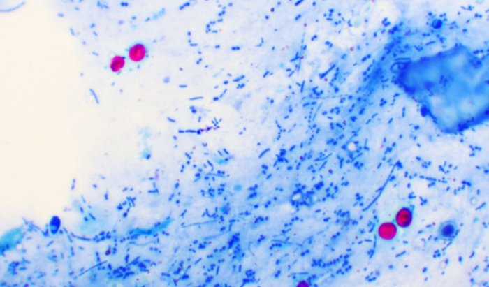 How globalisation could be making human parasites more virulent