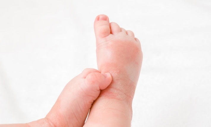 Natural fats in human skin link to eczema