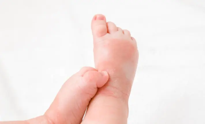 Natural fats in human skin link to eczema childhood eczema