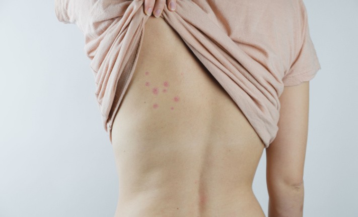 How to deal with a bedbug infestation