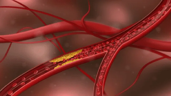 Atherosclerosis intervention in adolescence