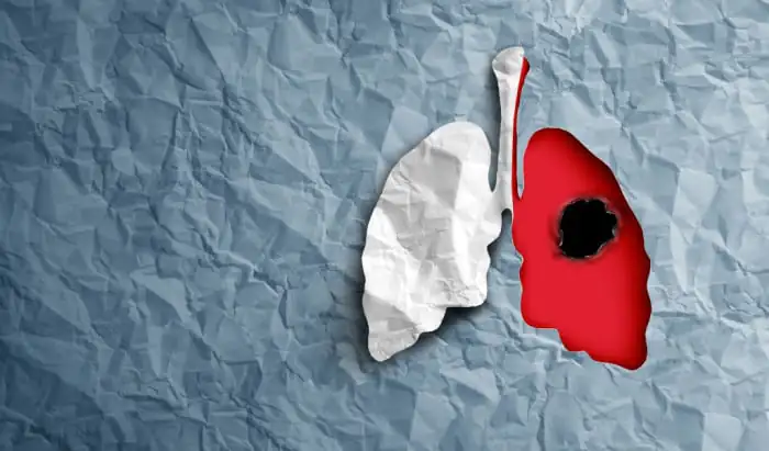 Small Cell Lung Cancer small cell
