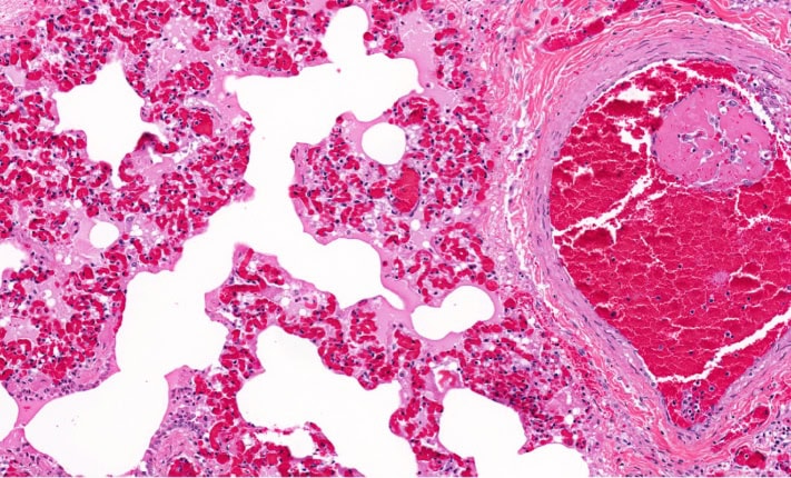 Venous thromboembolism in children
