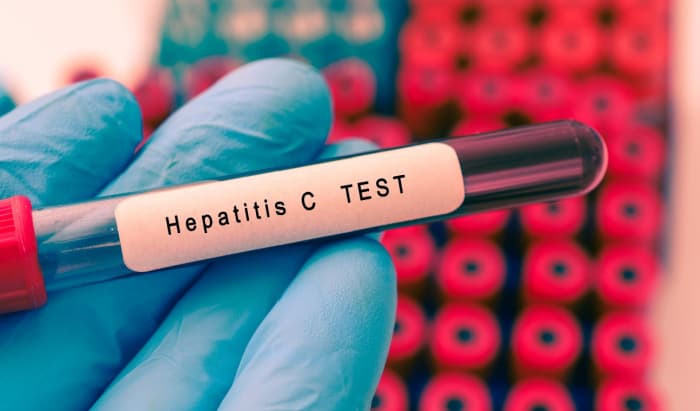 Hepatitis C: Accurate prediction following non-invasive testing