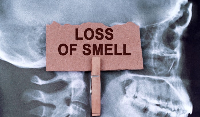COVID-19 infection alters gene transcription of olfactory mucosal cells in Alzheimer’s disease