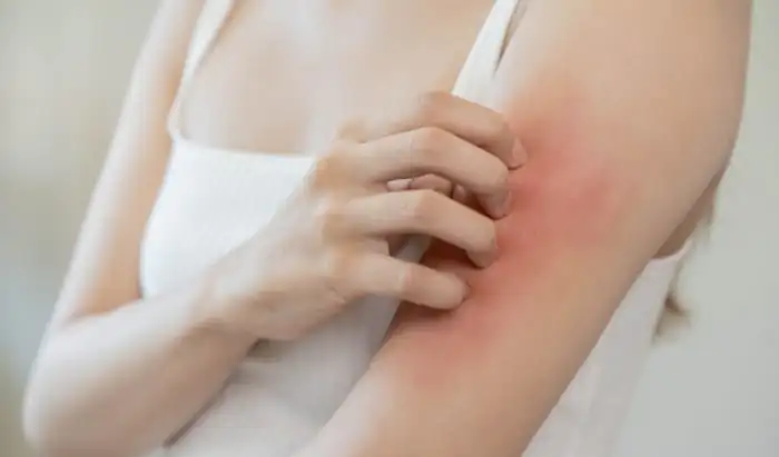 Fewer cases of melanoma among people with atopy people