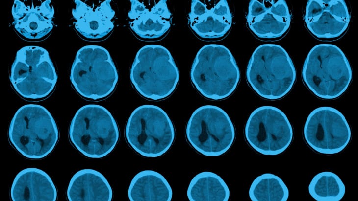 Symptoms of a brain tumour