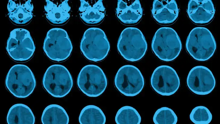 Symptoms of a brain tumour